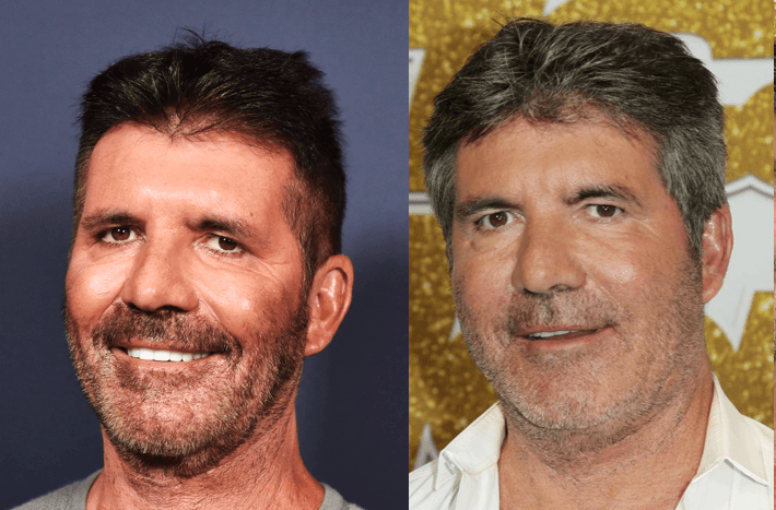 Simon Cowell before after