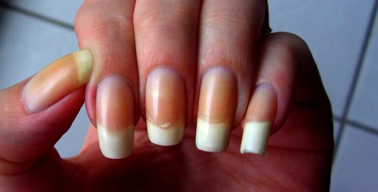 ongle jaune sante main