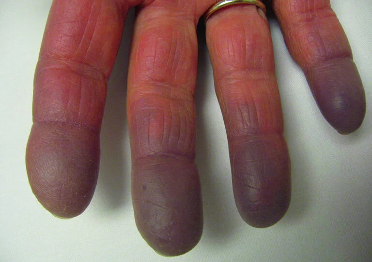 44 raynaud slide 18 springer high fr