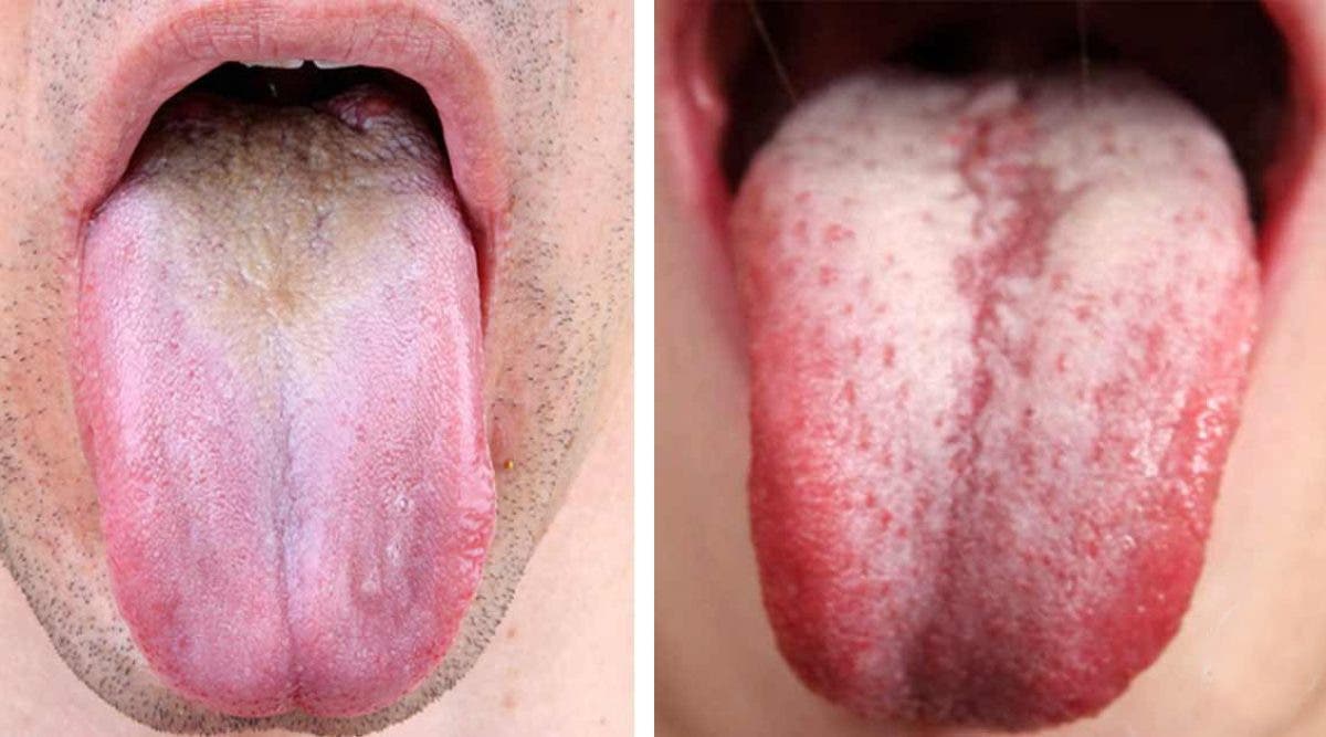 5 signes alarmants que votre langue renvoie sur votre sante 1 1200x667 1