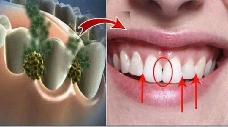 Eliminez la mauvaise haleine en 5 minutes Ce remede detruira toutes les bacteries qui provoquent la mauvaise haleine 1 1200x667 1