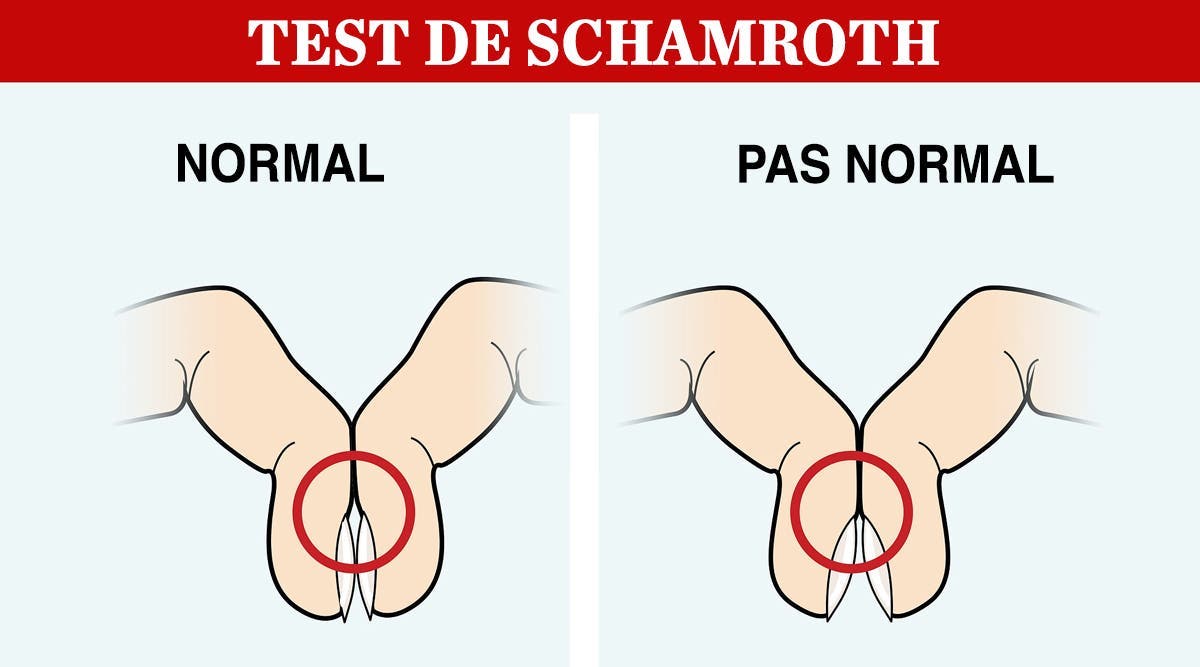Test de Schamroth