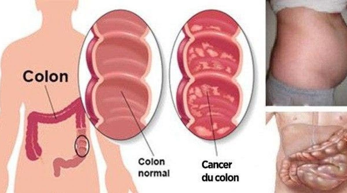 Voici les symptomes avant coureurs du cancer du colon 1