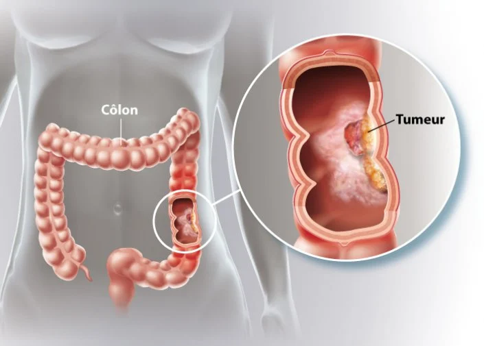 cancerducolon4 cancerducolon4