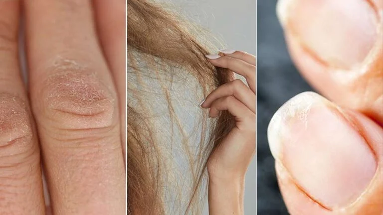 dry hair skin nails