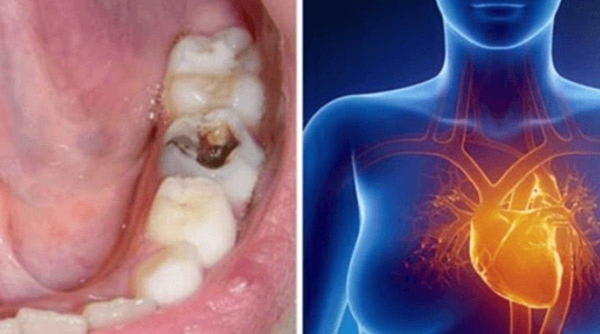 les caries dentaires peuvent causer une infection et toucher dautres organes du corps 1 1200x667 1