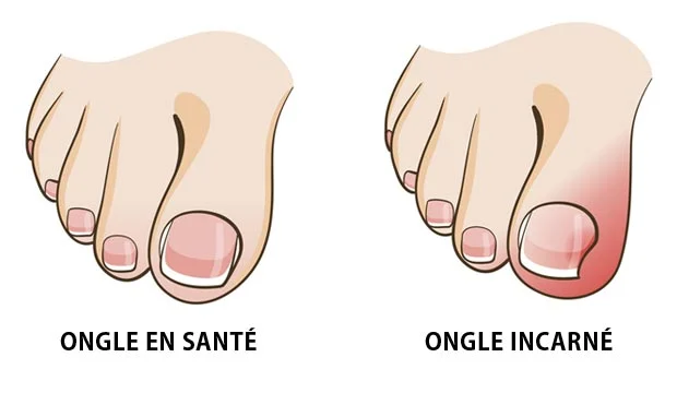 ongle incarne