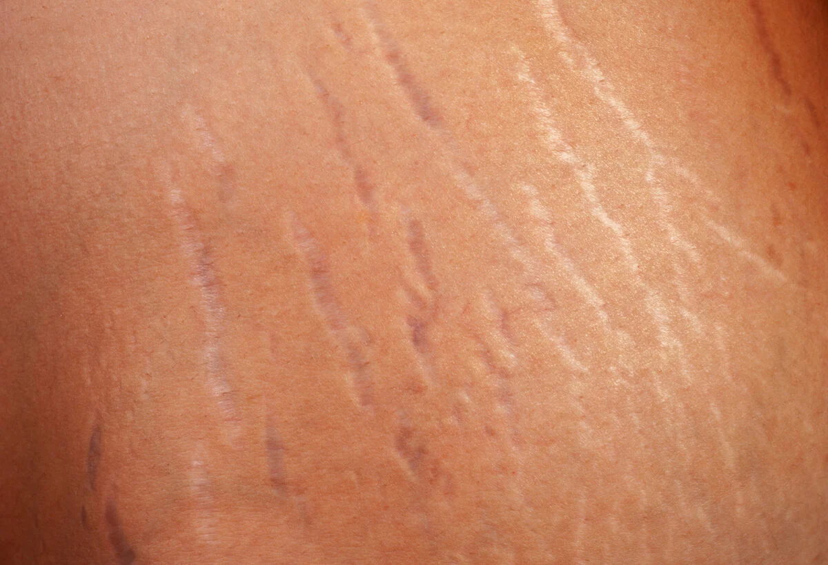 vergeture1 vergeture1
