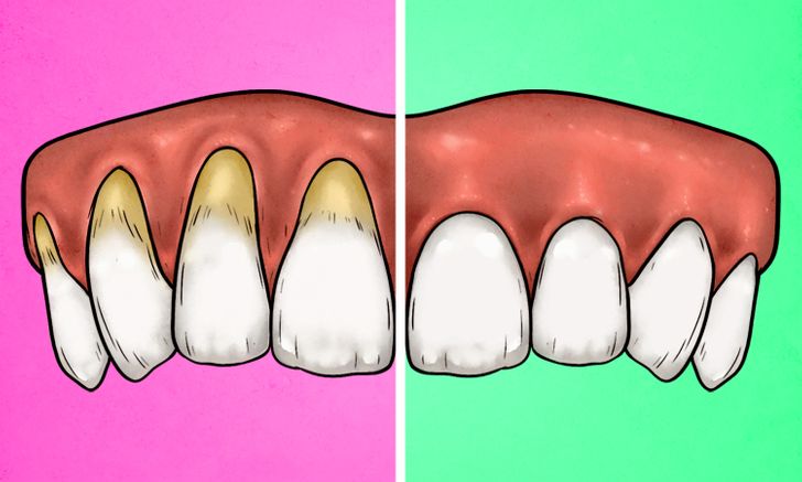 4 signes qui montrent que vous vous brossez les dents trop fort