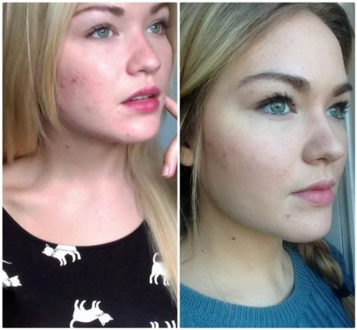 visage femme avant après