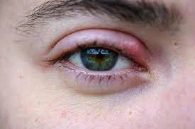 soigner orgelet naturellement œil yeux 