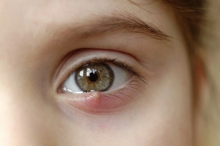 soigner orgelet naturellement œil yeux 