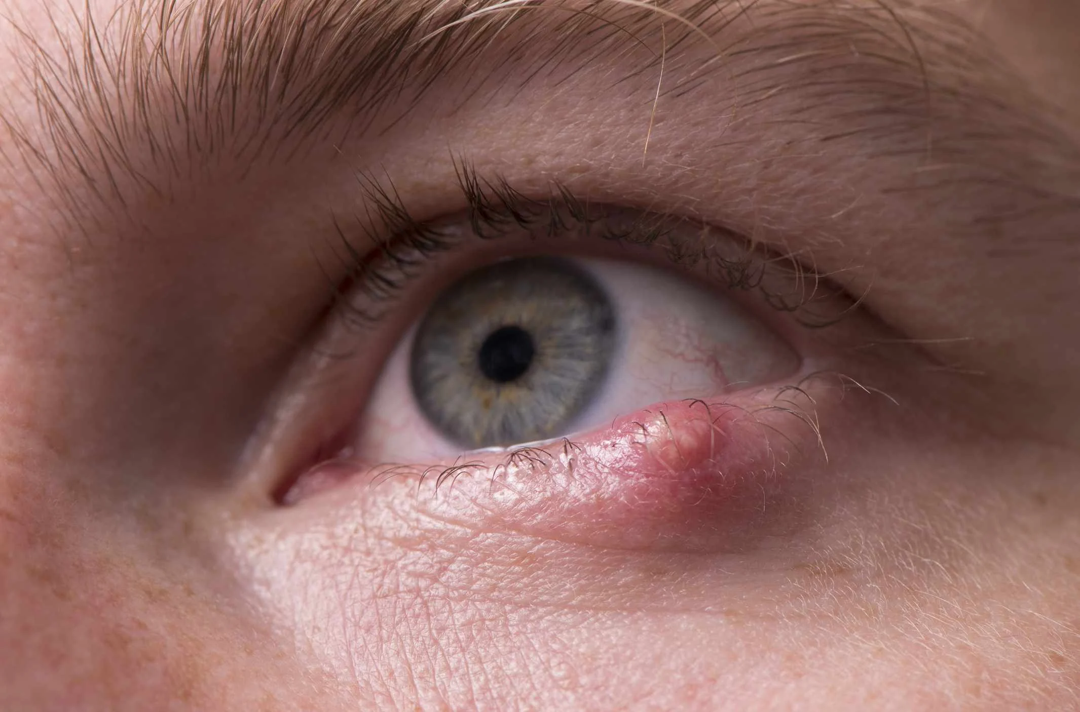 soigner orgelet naturellement œil yeux 