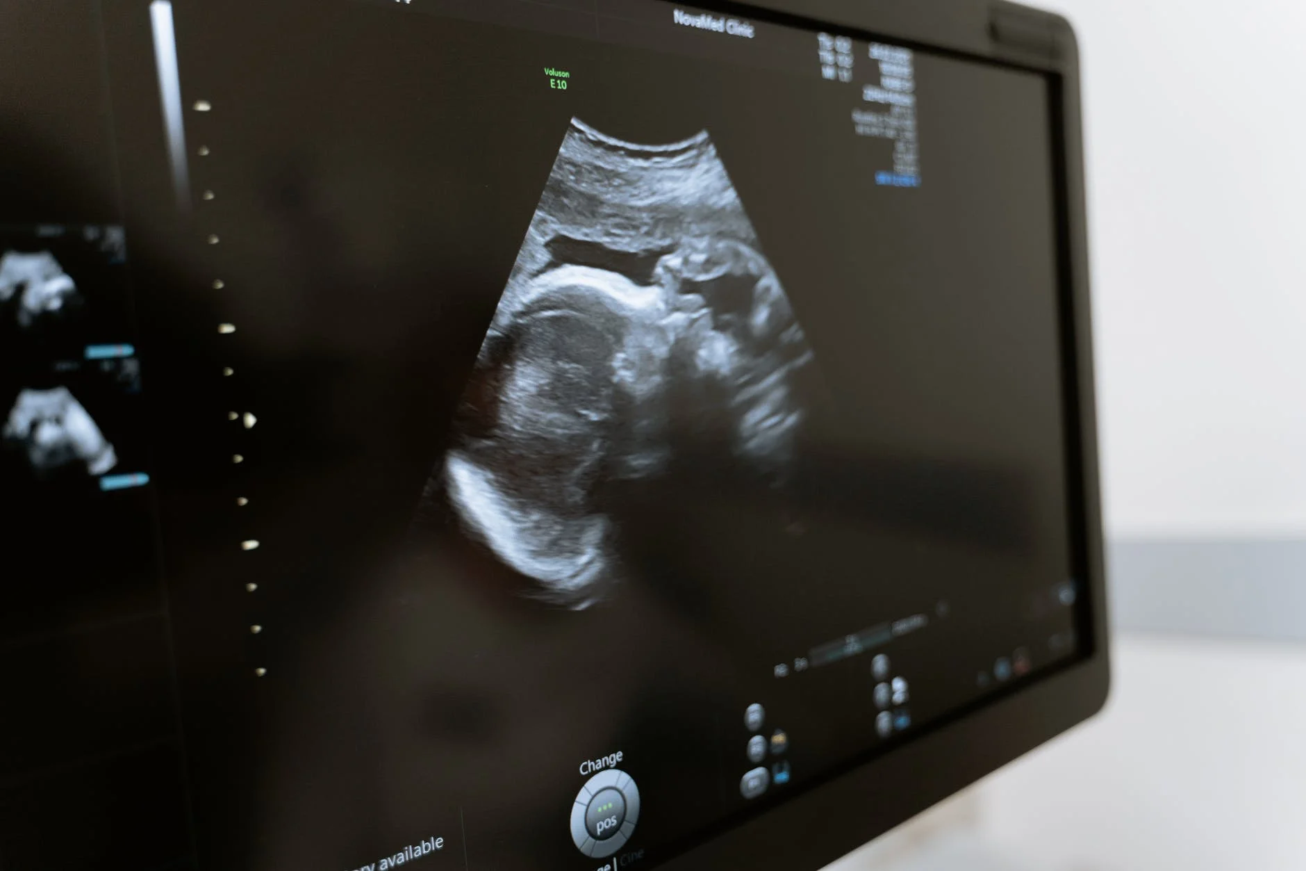 échographie bébé 