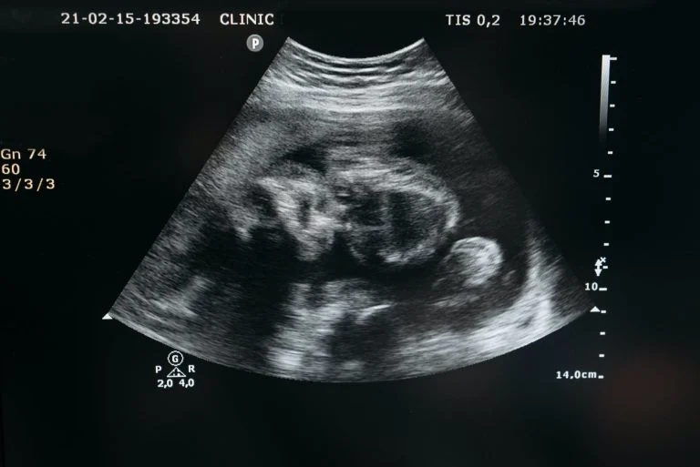 échographie bébé