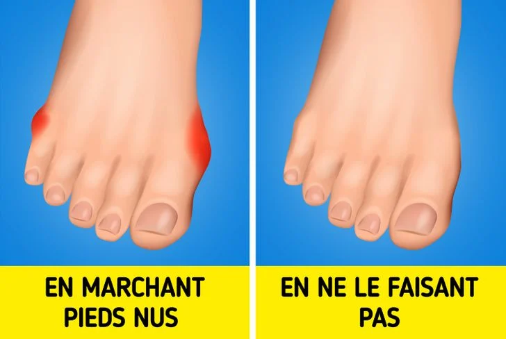 Voici les raisons pour lesquelles vous ne devriez pas vous promener pieds nus, même chez vous marcher pieds nus entraîner des blessures