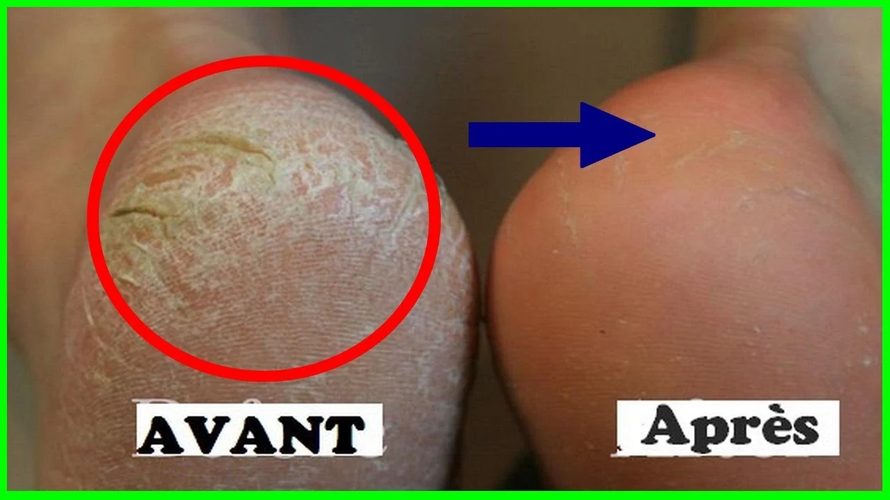 avant après talons secs et crevassés