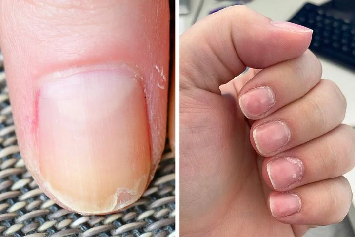 Ongles et cuticules décollés