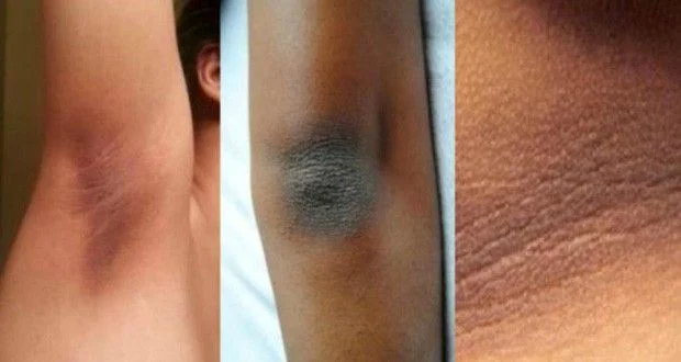 hyper pigmentation peau
