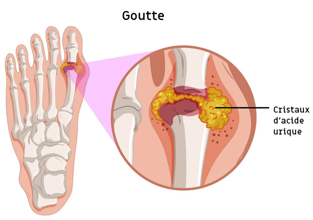 la goutte