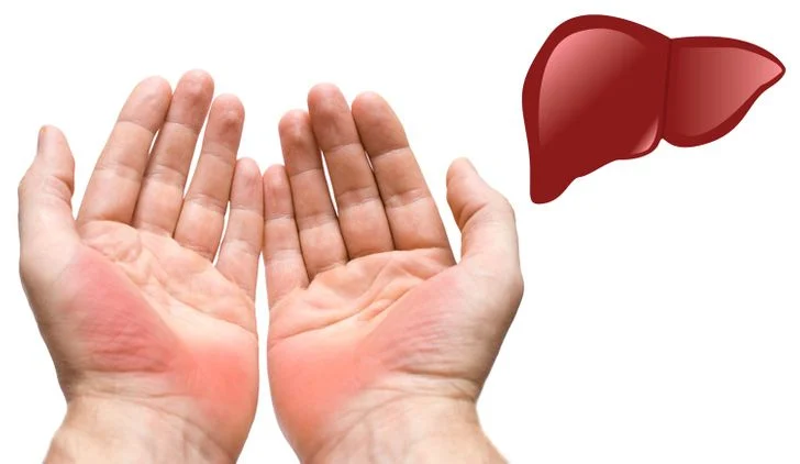 1. Paumes rouges tachetées