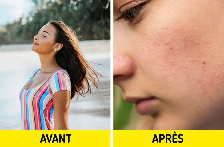 Le bronzage fait disparaître l'acné
