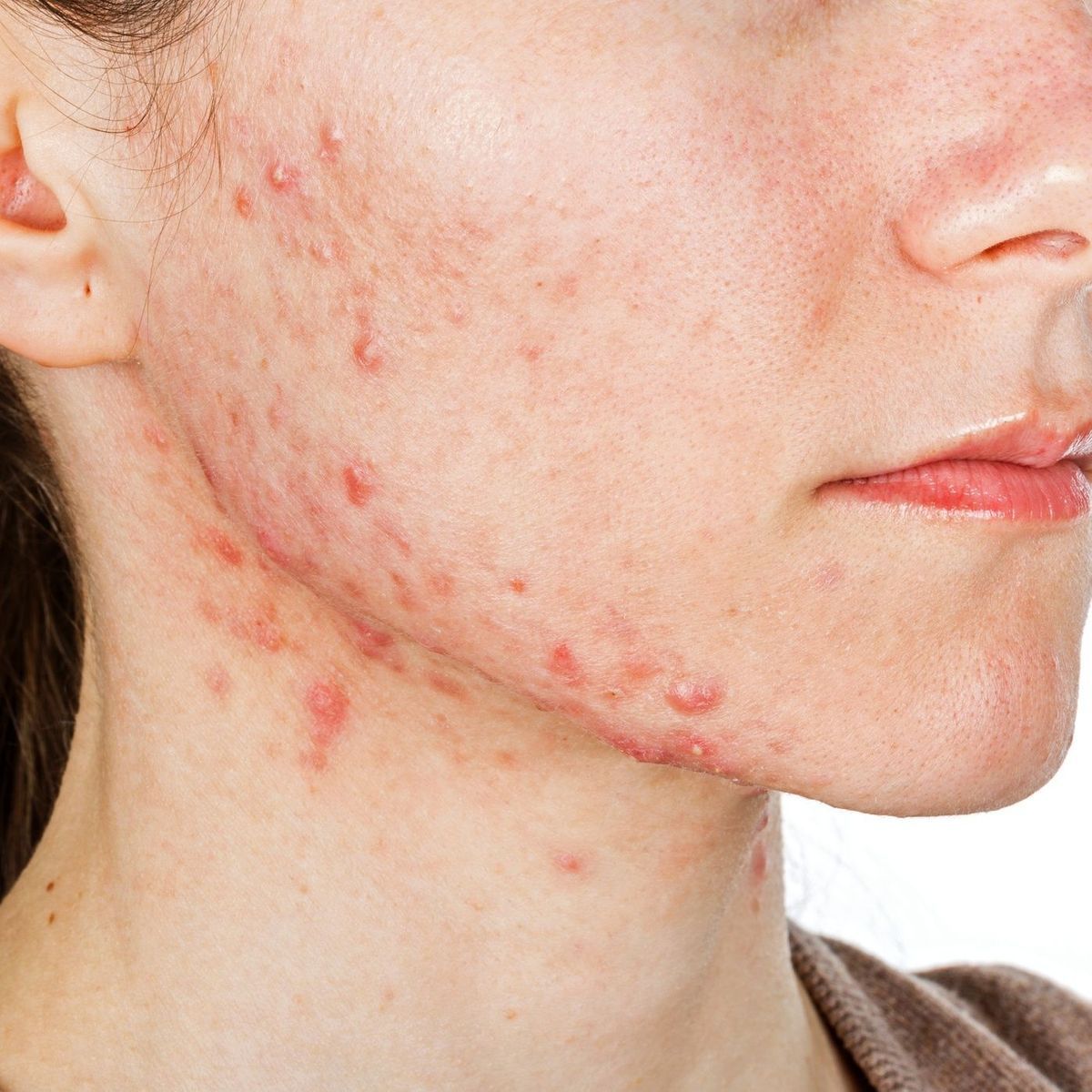 Votre acné n'a rien à voir avec ce que vous mangez