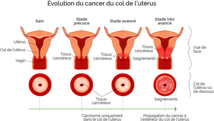  cancer du col de l'utérus 