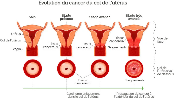 cancer du col de l'utérus