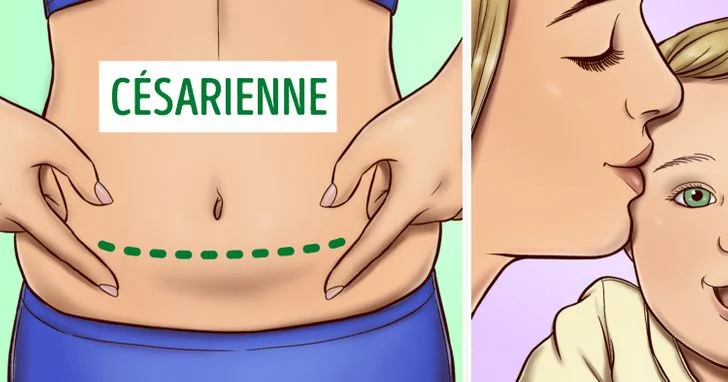 cicatrice césarienne femme