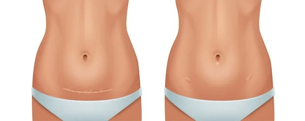 cicatrice césarienne femme