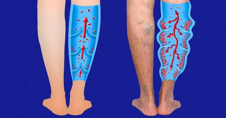 7 exercices pour aider à réduire les varices et les varicosités