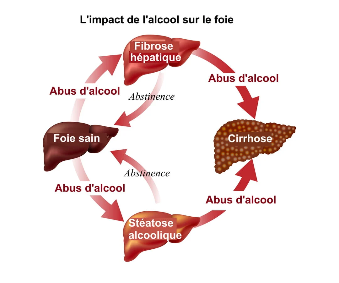 La stéatose hépatique alcoolique