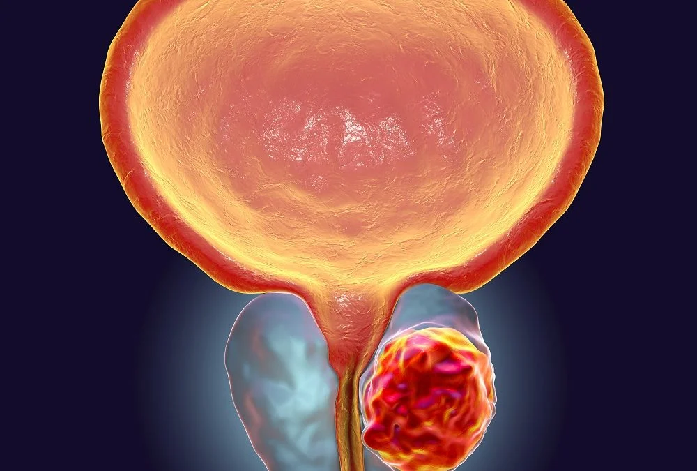 cancer de la prostate 