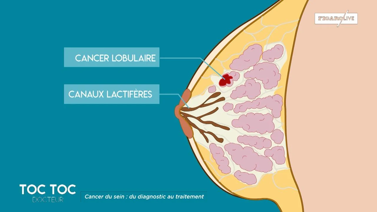 cancer du sein 