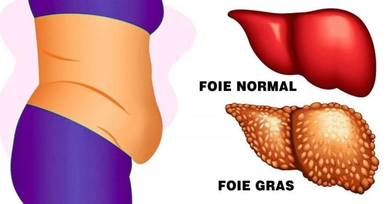 la maladie du foie gras