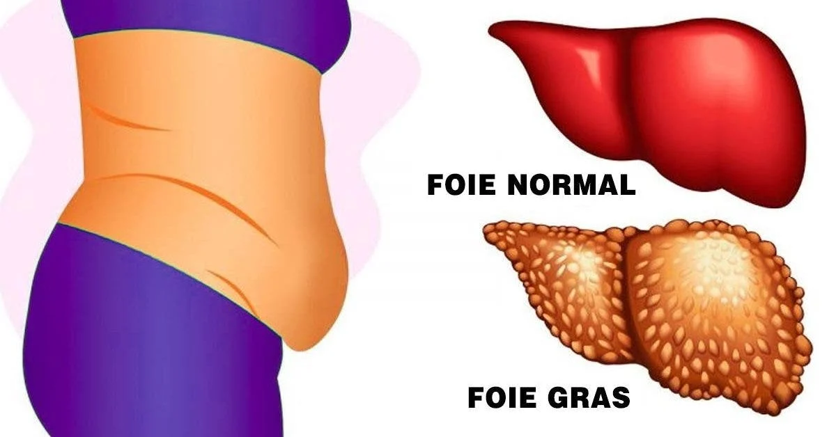 Qu’est-ce qui cause la maladie du foie gras ? Les conseils d’experts en matière de régime alimentaire pour gérer cette maladie la maladie du foie gras