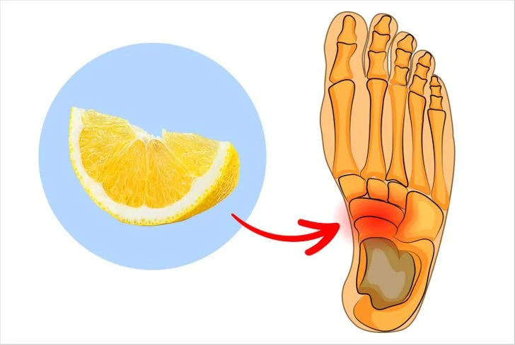 Arthrose