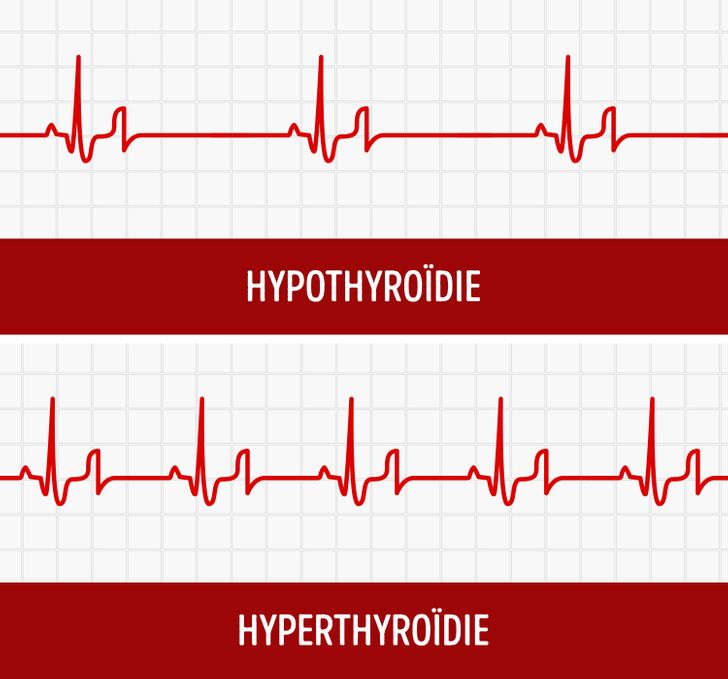 Augmentation du rythme cardiaque