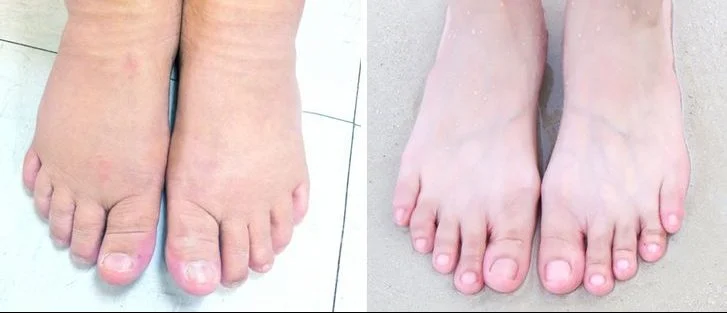 Bain contrasté pour les pieds enflés
