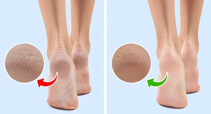 Cela peut aider à soulager les pieds secs