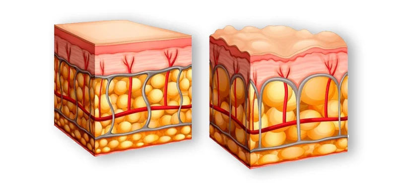 Croire que la cellulite dépend de la quantité d'eau que vous buvez