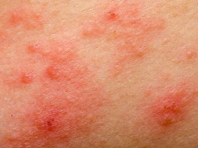 Eczéma