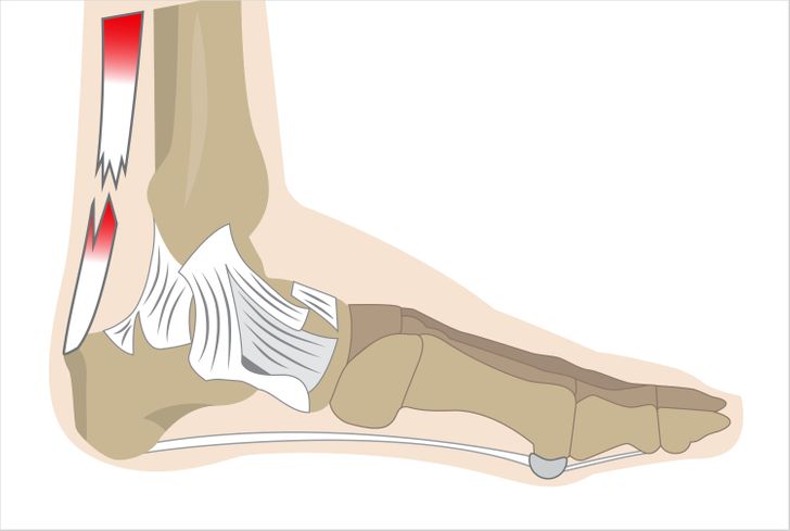Lésions du tendon d'Achille