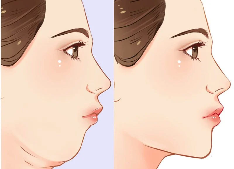 graisse du visage