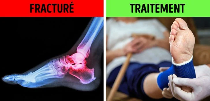 Fracture de l'os du talon