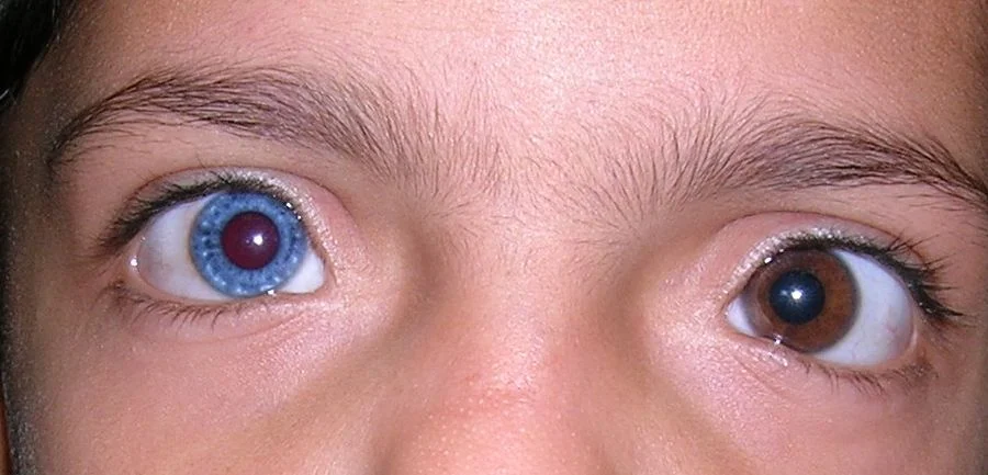 Heterochromia iridis