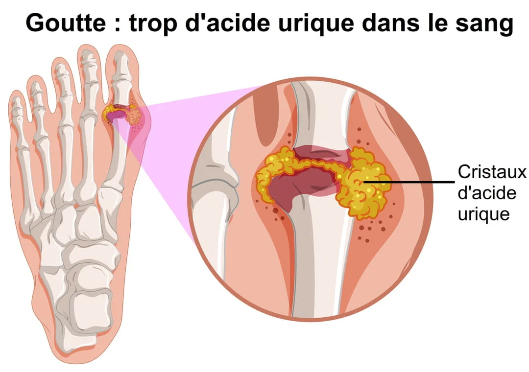 La goutte