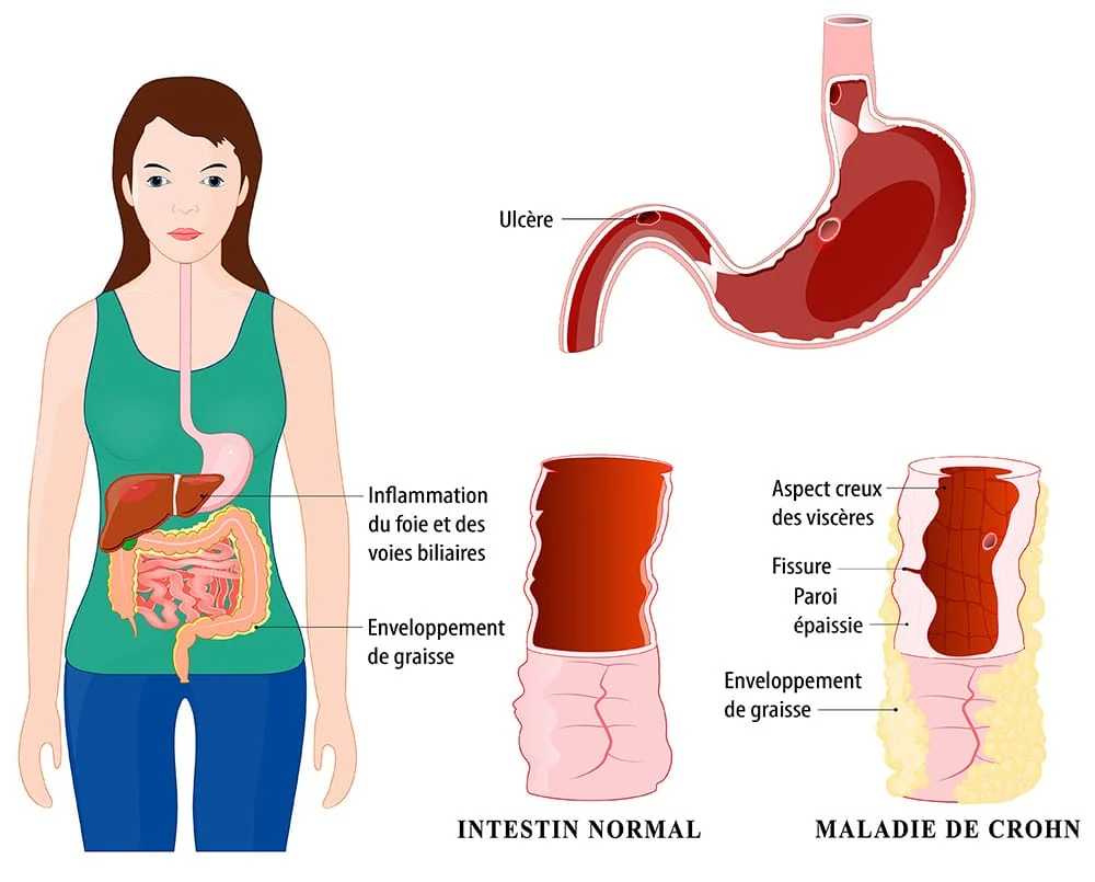 La maladie de Crohn