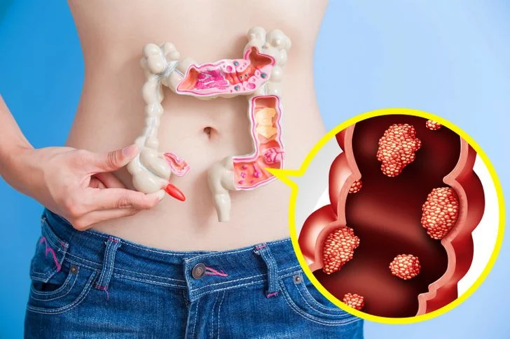 Le cancer colorectal